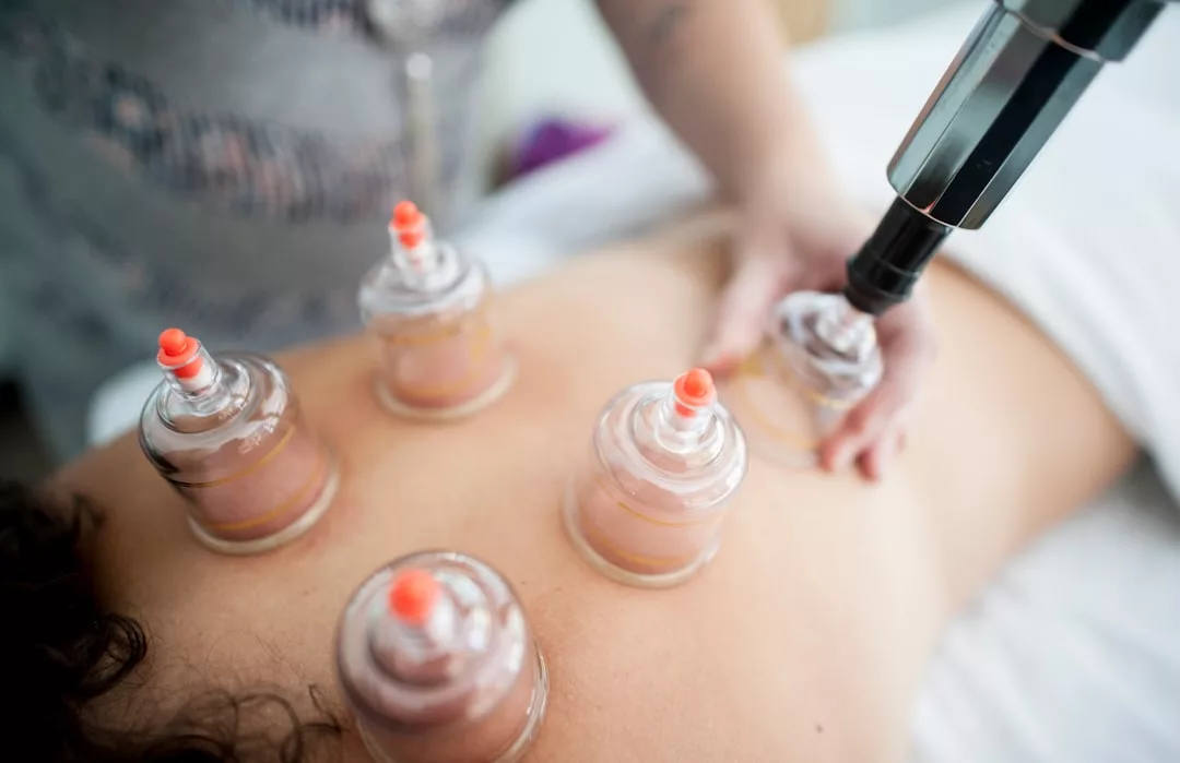 A person embraces a wellness lifestyle as they receive cupping therapy on their back, with several suction cups expertly applied by a practitioner.