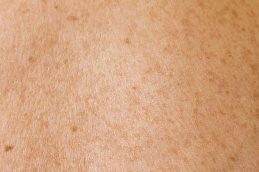 Close-up of human skin with visible freckles and small brown spots, showcasing unique beauty in a lifestyle and fashion context.