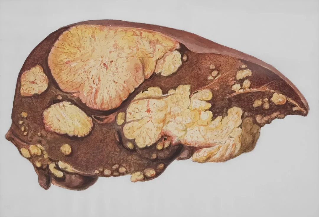 Illustration of a human liver with multiple large yellowish tumors, highlighting how even a luxury lifestyle can't protect against advanced liver disease or cancer.